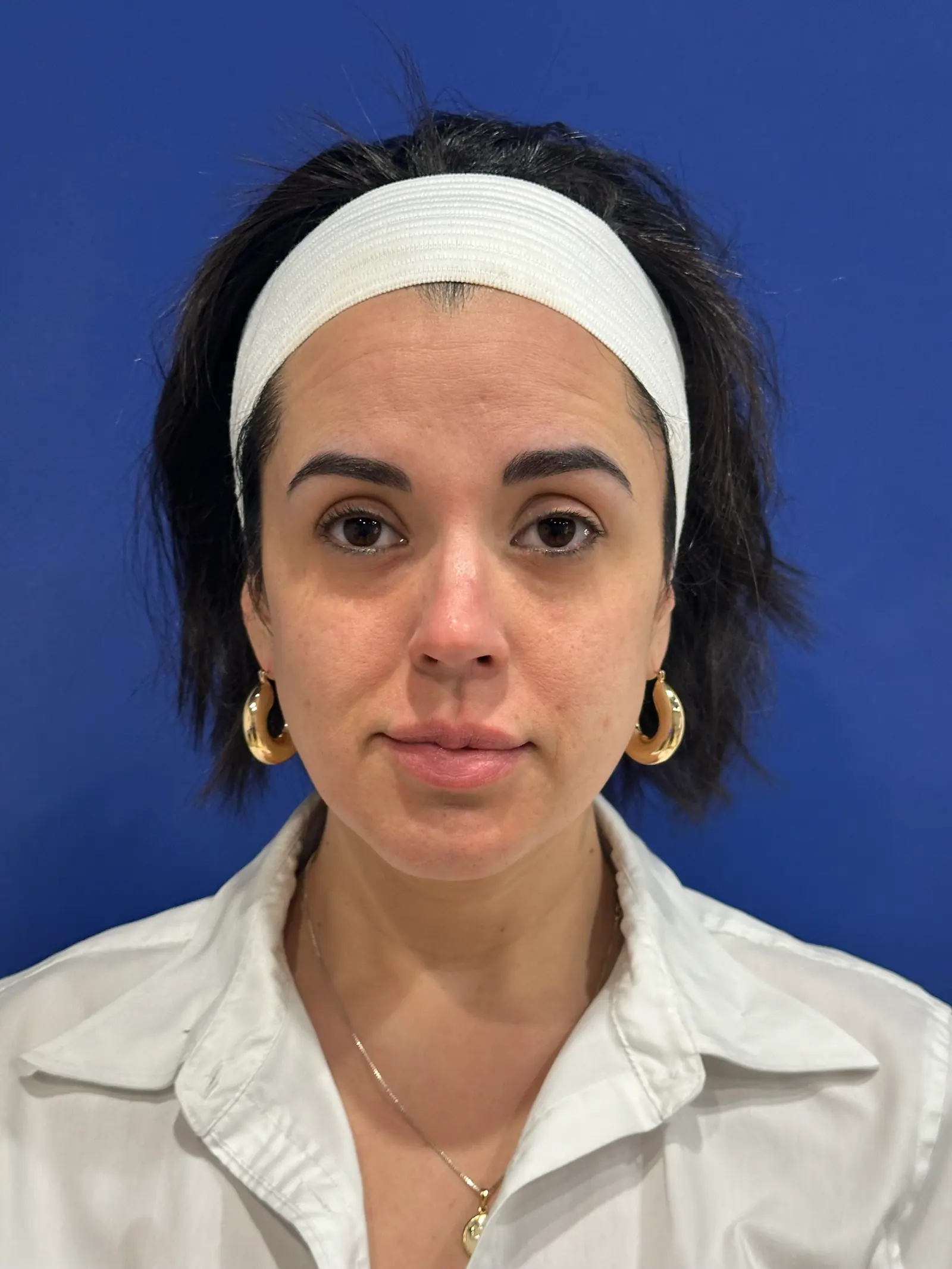 Under-Eye + Mid-Cheek Filler by Mini before treatment