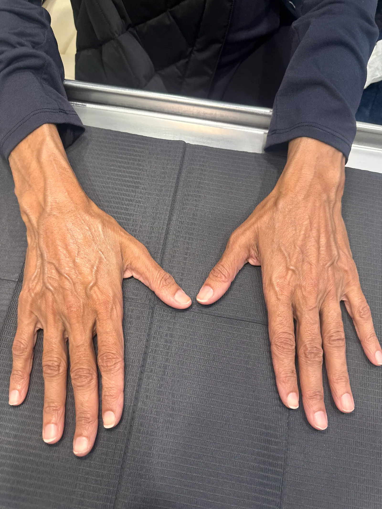 Hand Rejuvenation by Mini before treatment