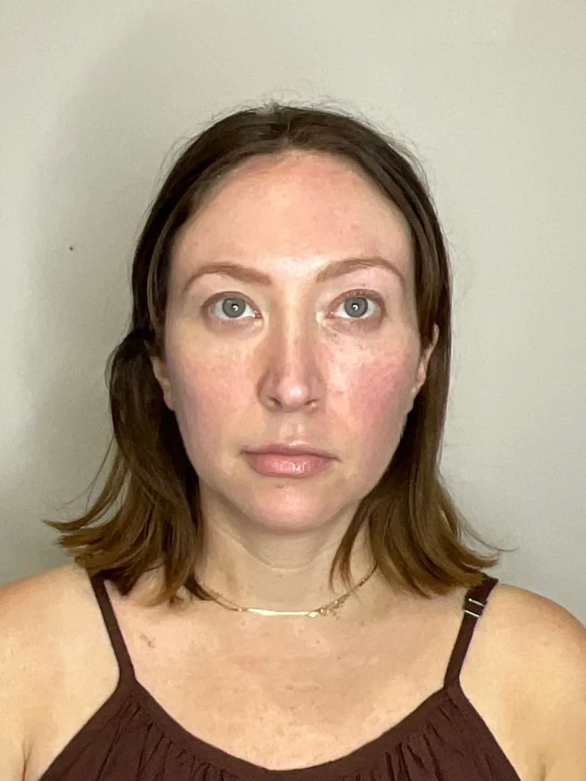 Facial Balancing by Mini before treatment