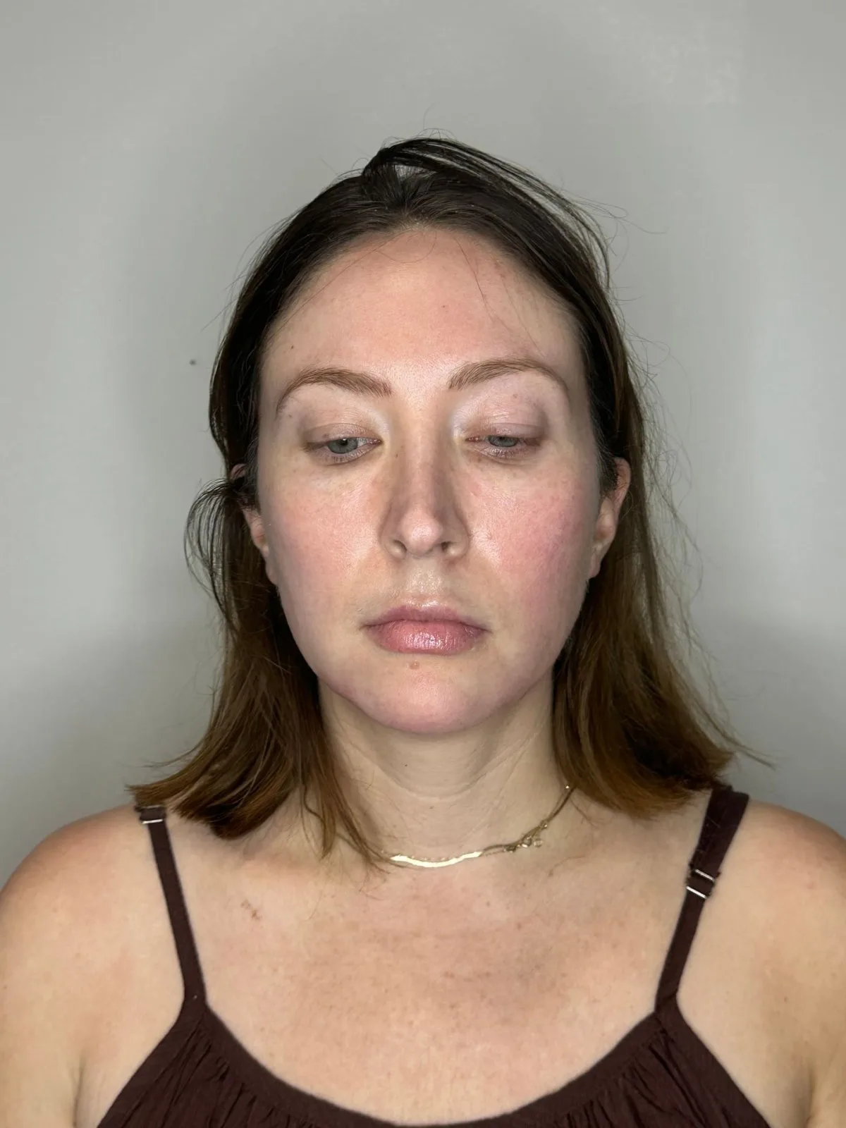 Facial Balancing by Mini before treatment