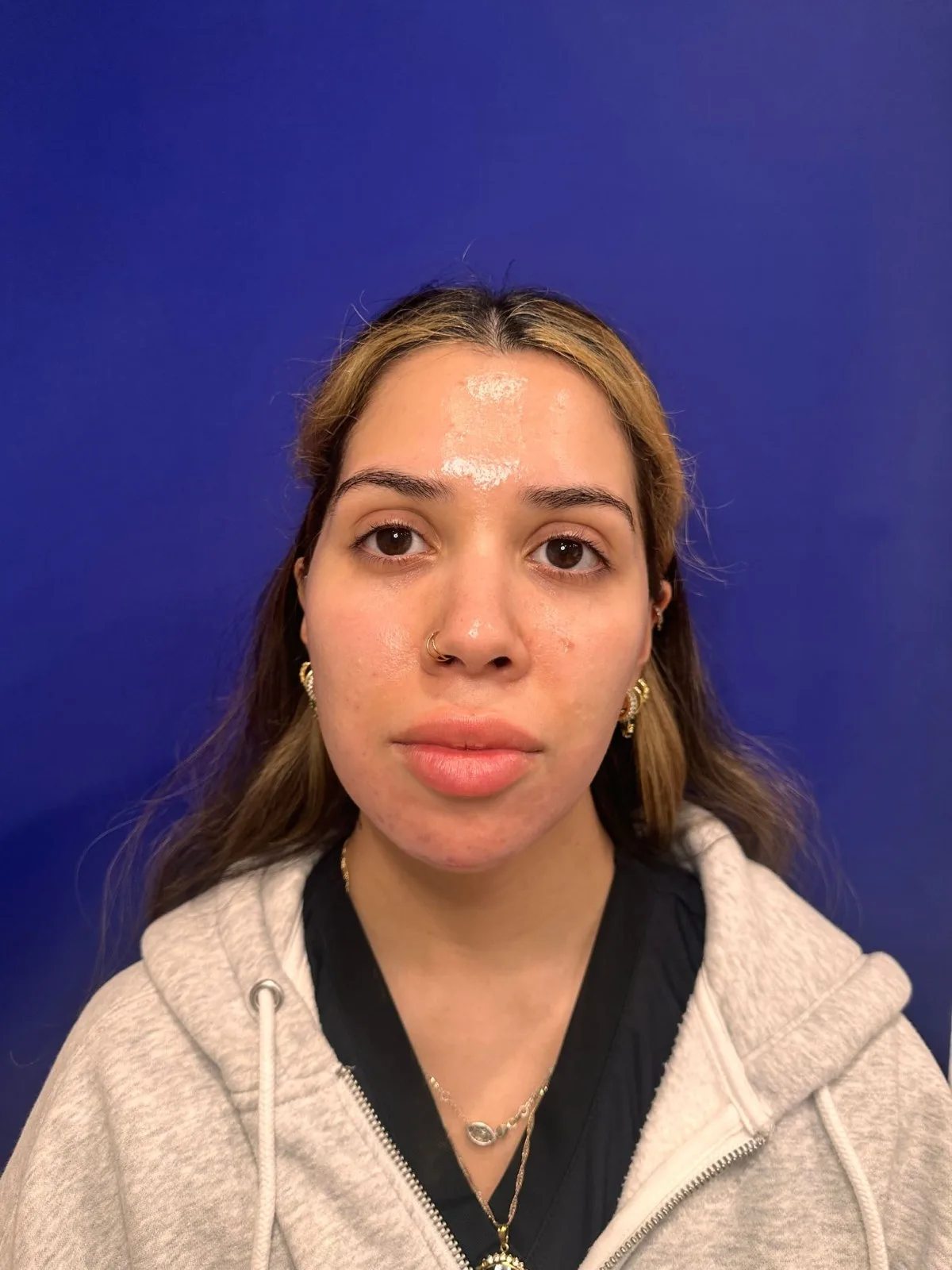 Facial Balancing Case 2 by Mini before treatment