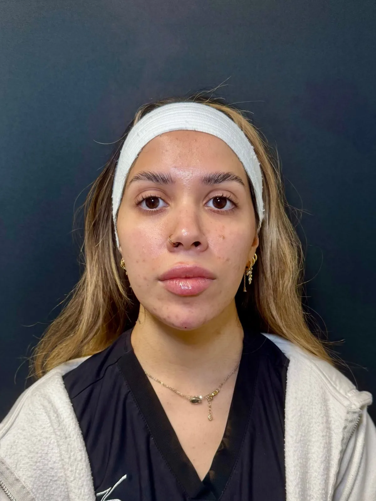 Facial Balancing Case 2 by Mini before treatment