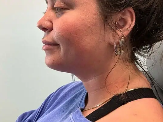 Patient Receives Kybella®, Transforming Their Appearance before treatment