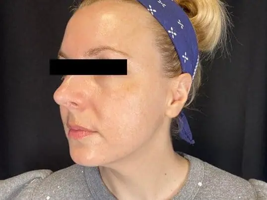 Lasers after treatment at ZO Skin Centre