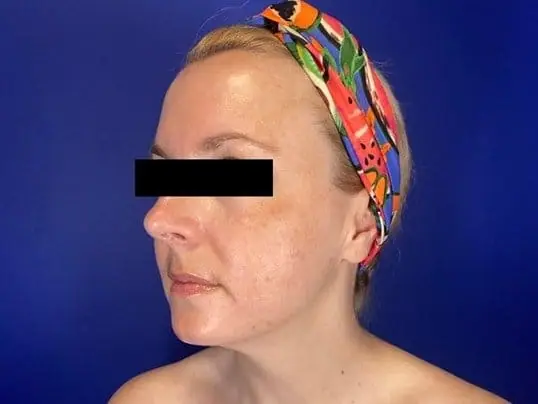 Clear + Brilliant Laser Resurfacing, 1 Month Apart before treatment