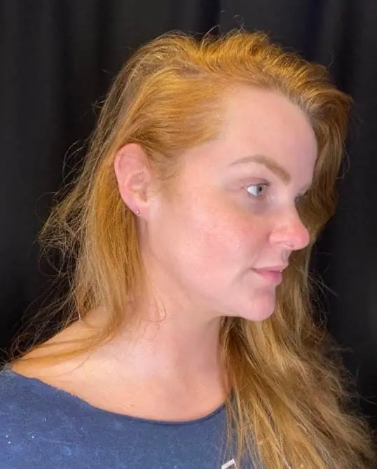 Clear + Brilliant after treatment at ZO Skin Centre