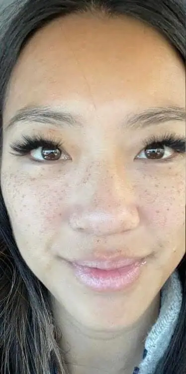 IPL Photofacial for Sun Damage & Pigment before treatment