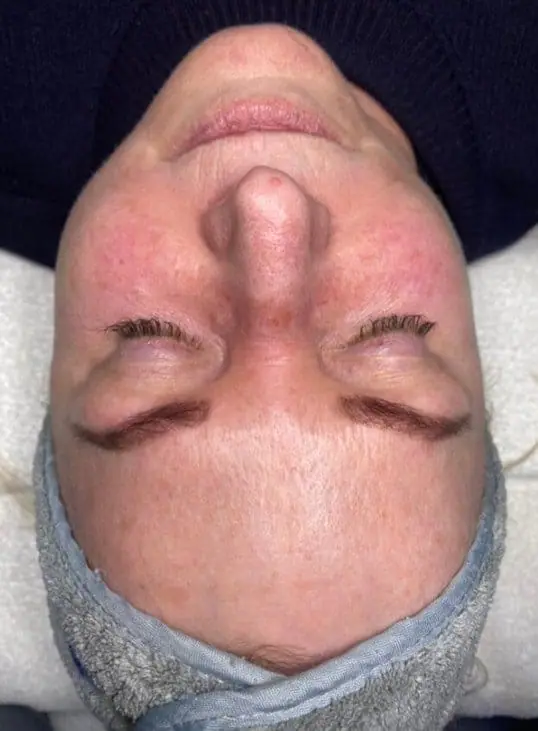 IPL/Photofacial before treatment