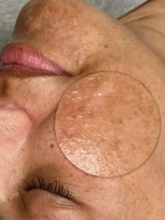 Clear + Brilliant before treatment