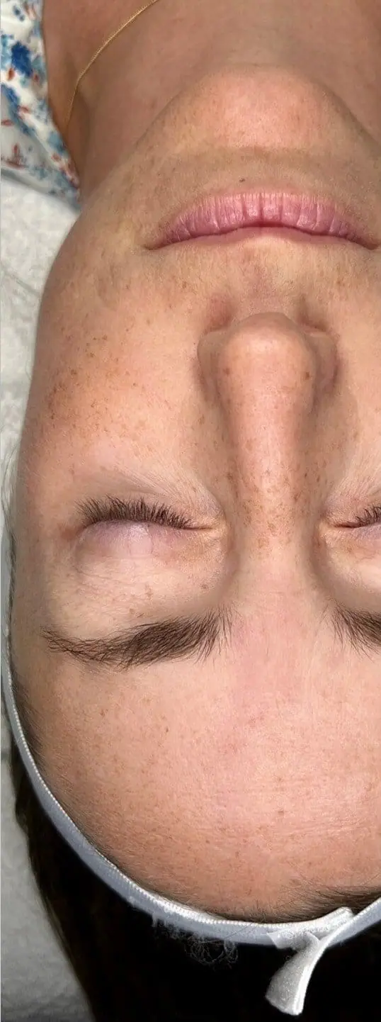 Patient Receives IPL and ZO Skin Health Protocol before treatment