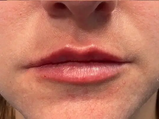 Lip Filler after treatment at ZO Skin Centre