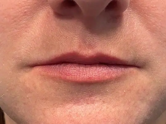 Lip Filler before treatment at ZO Skin Centre