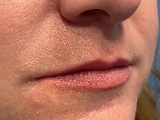 Beautiful Lips with Restylane refyne before treatment