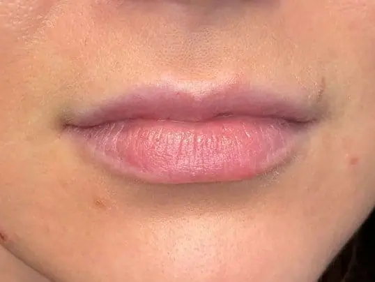 Restylane Lip Fillers before treatment