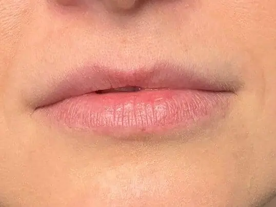 1 Syringe of Restylane Kysse Lip Filler before treatment