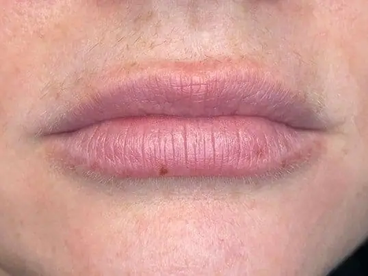 Restylane Kysse lip filler before treatment