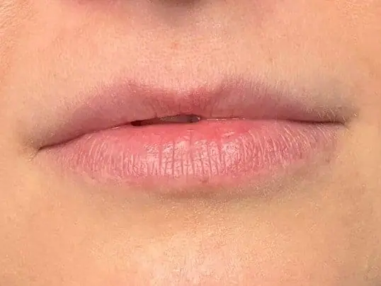 Restylane Kysse Lip Fillers before treatment