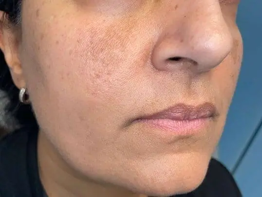 Versa Lip Filler: Subtle Volume Refresh before treatment