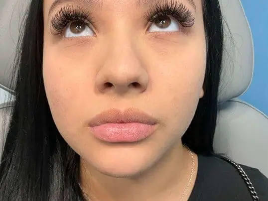 Voluptuous Lips Using Revanesse before treatment