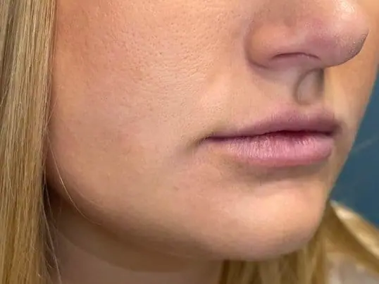 Versa lip filler for volume and hydration before treatment