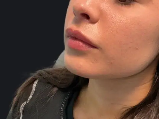Beautiful Restylane Lip Filler Treatment before treatment