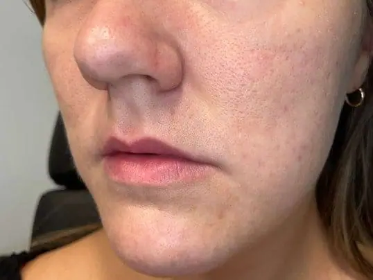 Restylane KYSSE lip enhancement before treatment