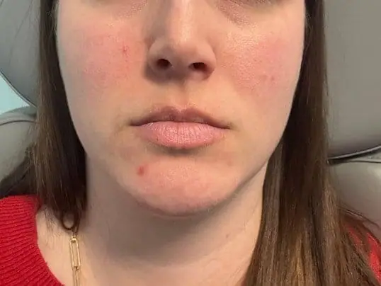 Restylane® Kysse lip enhancement before treatment
