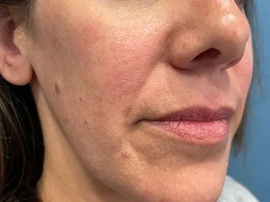 Restylane Kysse Lip Filler before treatment