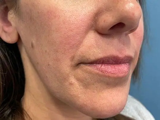 Restylane® Kysse treatment before treatment