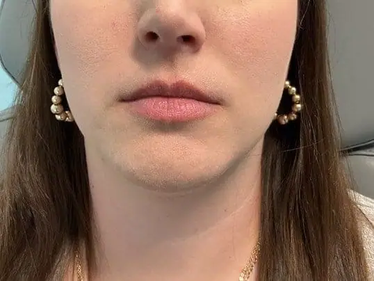 Restylane Lip Filler Treatment before treatment