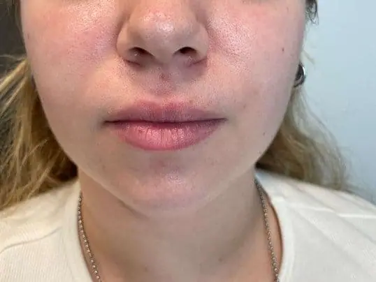 Patient Receives Restylane for Lip Enhancement before treatment