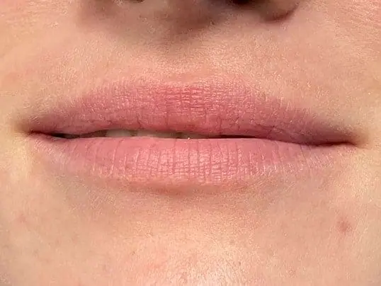 Beautiful Lip Transformation using Versa before treatment