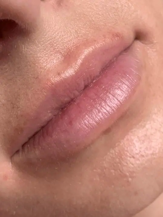 Voluptuous Lips Using Restylane Kysse before treatment