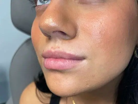 Juvéderm Volbella Lip Enhancement before treatment