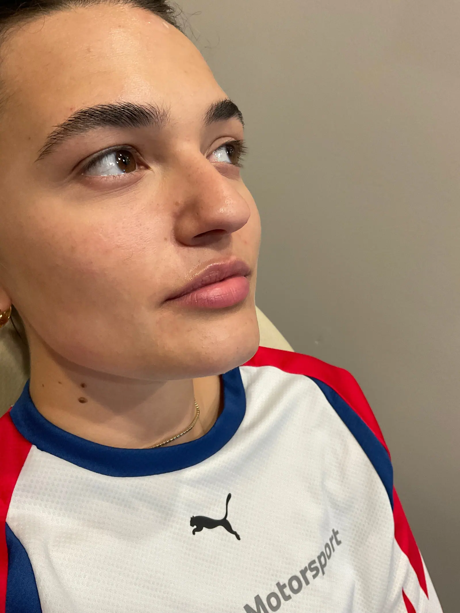 Mini Lip Filler Case 1 before treatment