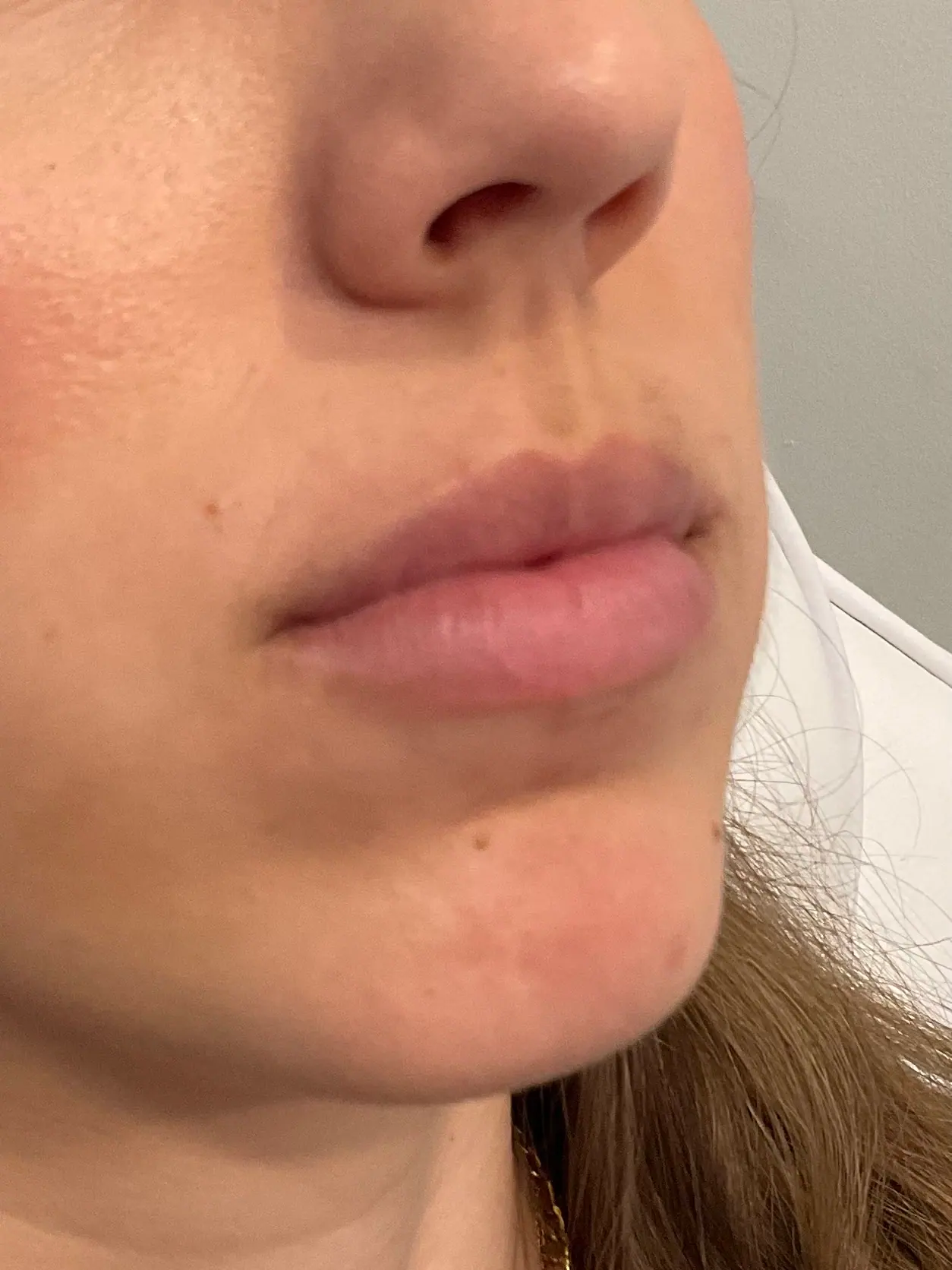Mini Lip Filler Case 2 before treatment