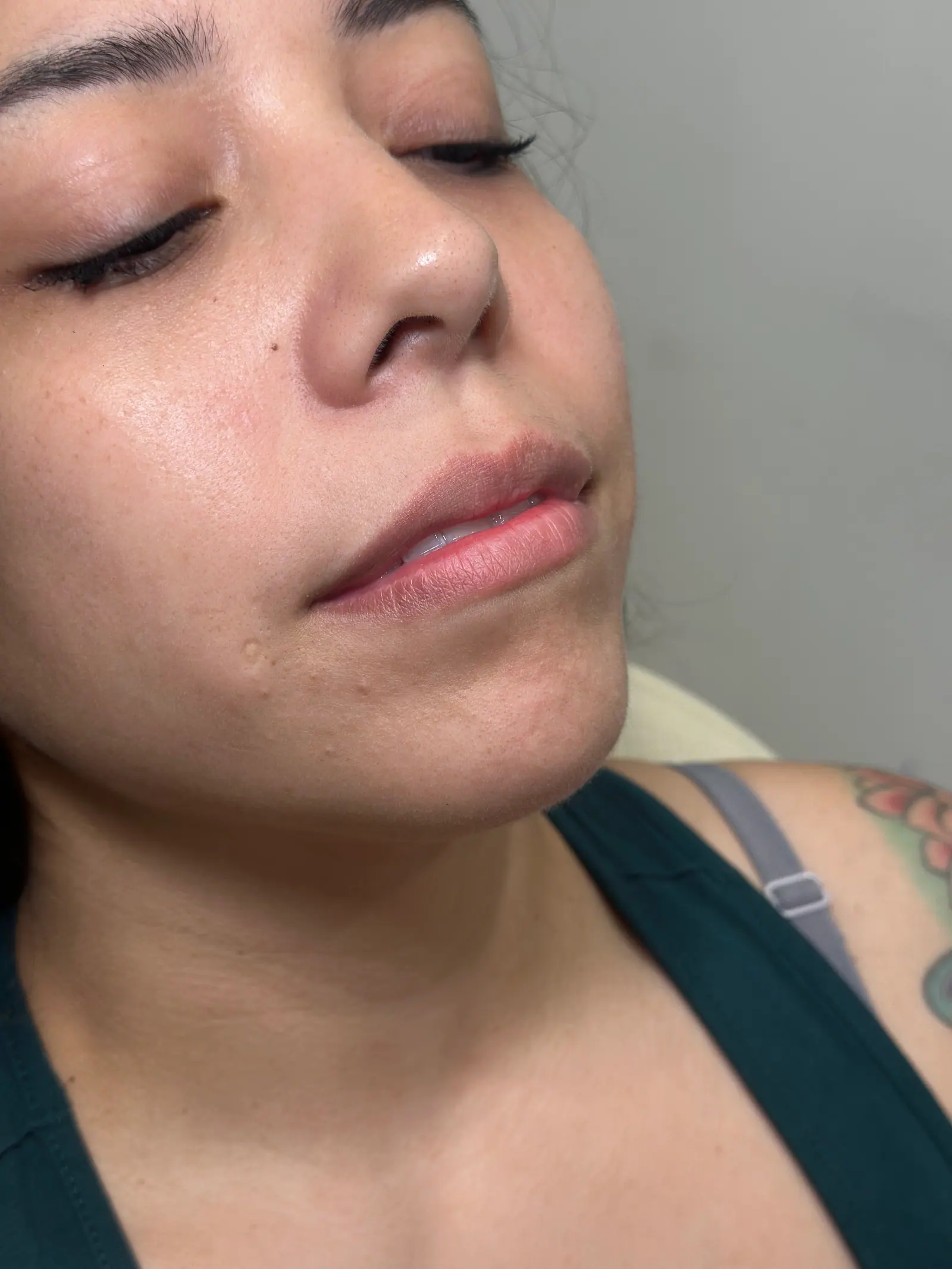 Mini Lip Filler Case 3 before treatment