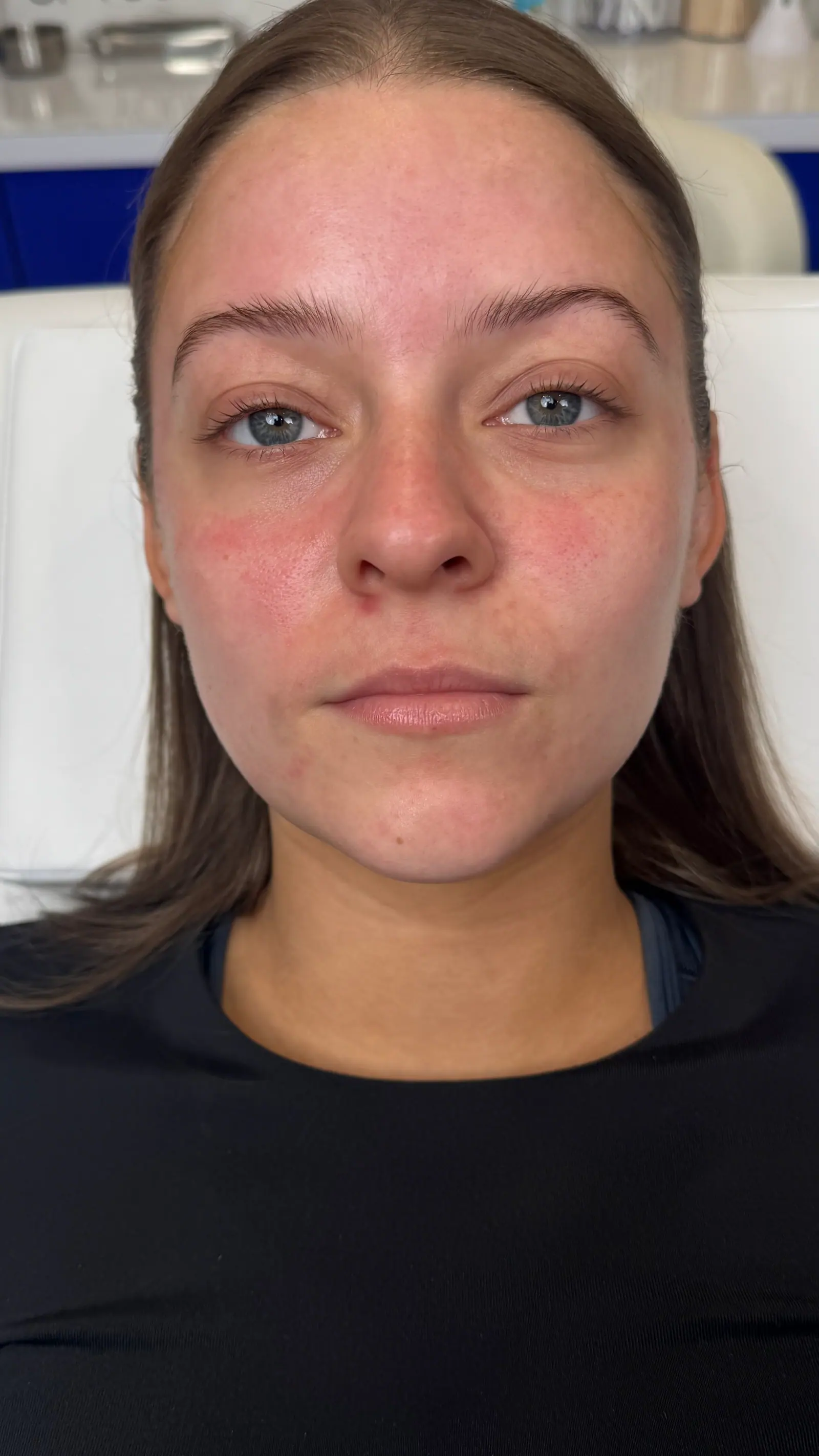 Mini Lip Filler Case 4 before treatment