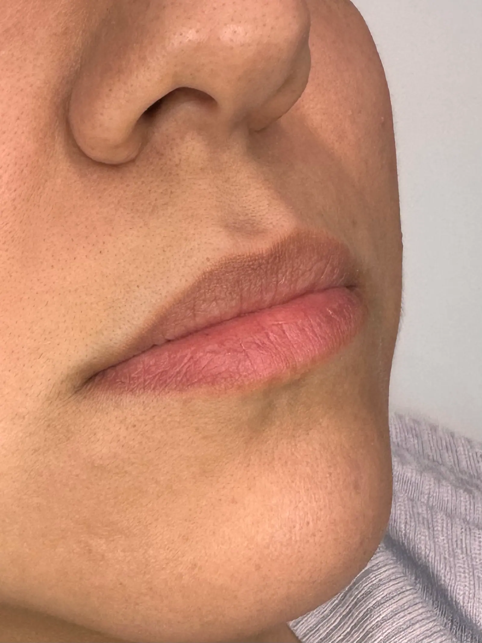 Mini Lip Filler Case 5 before treatment
