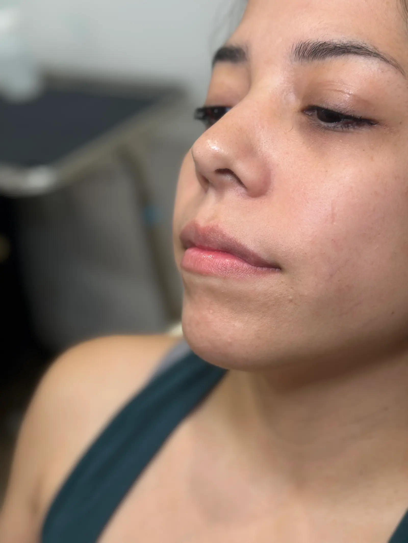 Mini Lip Filler Case 6 before treatment