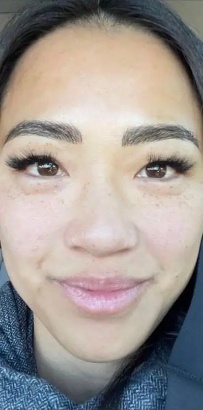 Lumecca IPL after treatment at ZO Skin Centre
