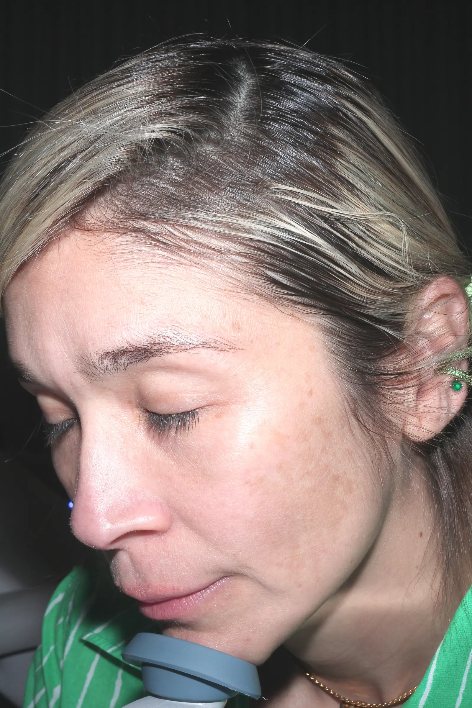 Melasma Treatment by Mini before treatment