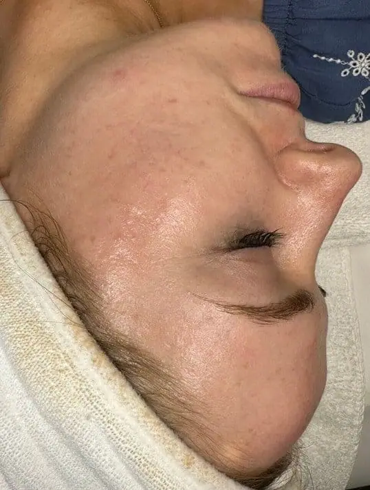 Microneedling after treatment at ZO Skin Centre