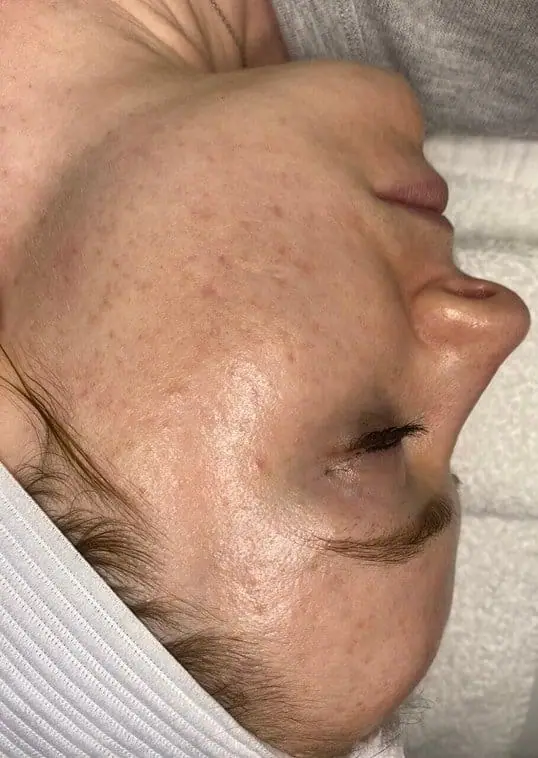 Microneedling before treatment at ZO Skin Centre
