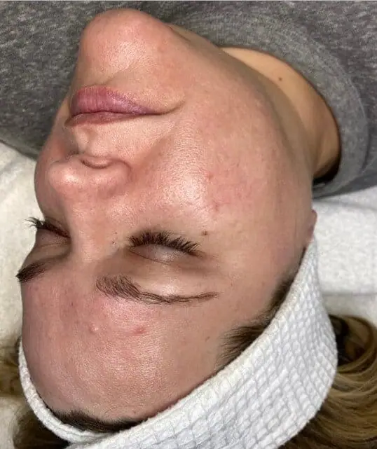 Beautiful Skin Rejuvenation Treatment Results before treatment