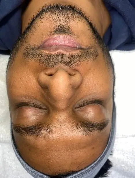 Patient Receives HydraFacial® MD® and SkinPen Microneedling Treatment before treatment