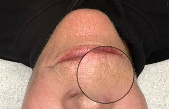 Morpheus8® after treatment at ZO Skin Centre
