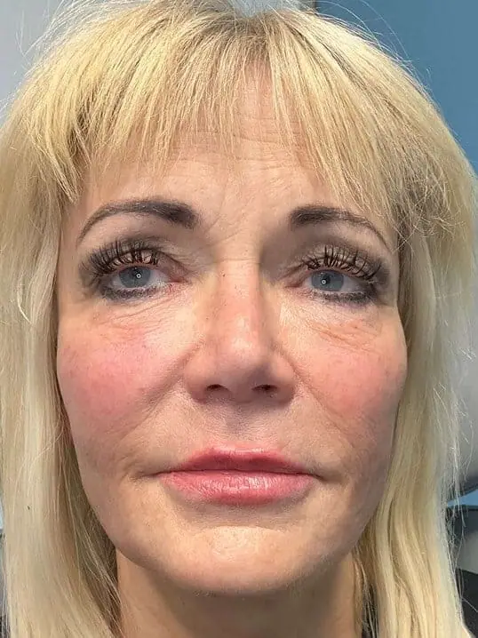 Sculptra® Glow after treatment at ZO Skin Centre